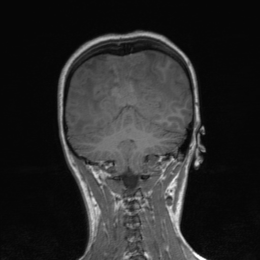 Cerebral tuberculosis with dural sinus invasion (Radiopaedia 60353-68090 Coronal T1 137).jpg