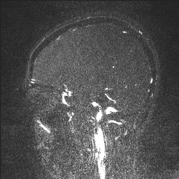 Cerebral tuberculosis with dural sinus invasion (Radiopaedia 60353-68090 Sagittal MRV 44).jpg
