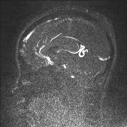 Cerebral tuberculosis with dural sinus invasion (Radiopaedia 60353-68090 Sagittal MRV 76).jpg