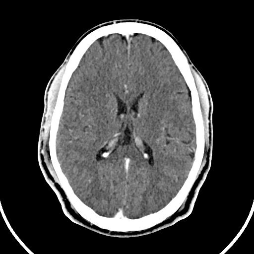 Cerebral venous angioma (Radiopaedia 69959-79977 B 56).jpg