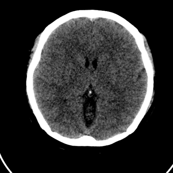 File:Cerebral venous hemorrhagic infarct from venous sinus thrombosis (Radiopaedia 55433-61879 Axial non-contrast 12).jpg