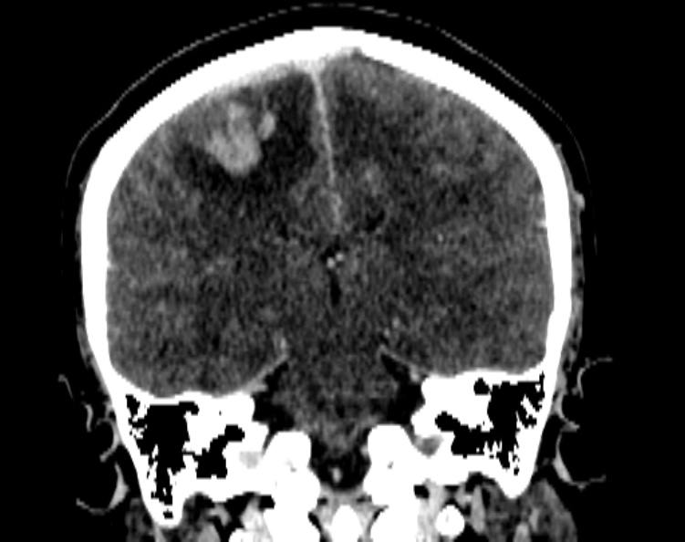 Cerebral venous hemorrhagic infarct from venous sinus thrombosis (Radiopaedia 55433-61883 Coronal C+ delayed 38).jpg