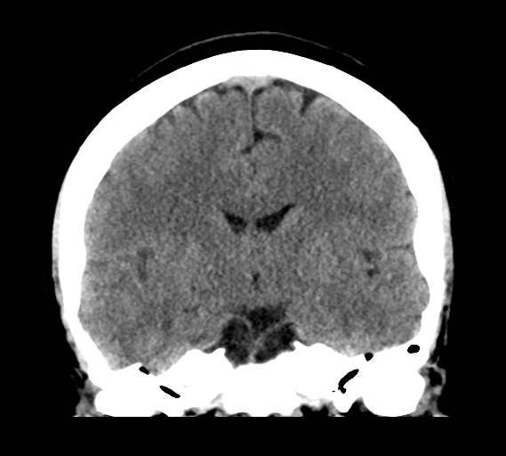 File:Cerebral venous infarct related to dural venous sinus thromboses (Radiopaedia 35292-36804 Coronal non-contrast 18).png