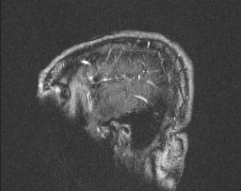 Cerebral venous infarction (Radiopaedia 65166-74176 Sagittal TOF 66).jpg