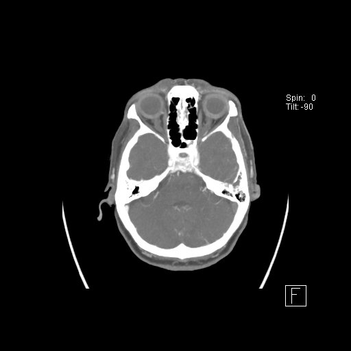 Cerebral venous infarction with hemorrhage (Radiopaedia 65343-74396 A 28).jpg