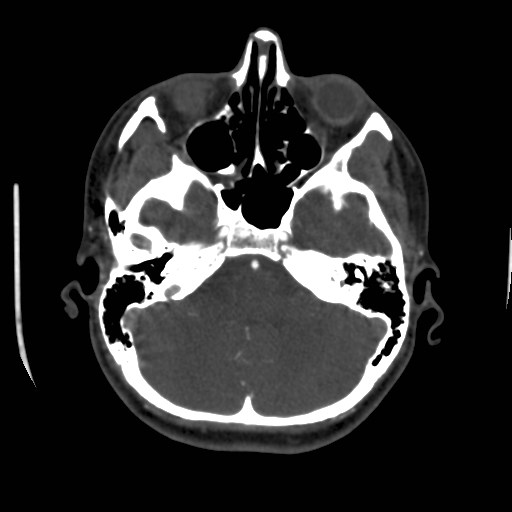 Cerebral venous sinus thrombosis (Radiopaedia 40619-43227 A 52).jpg