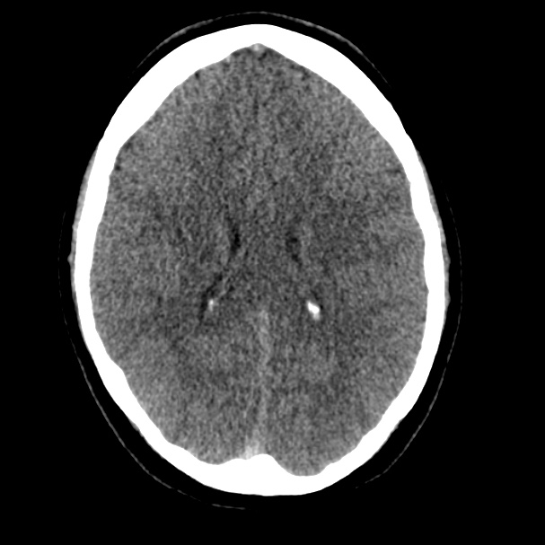 Cerebral venous sinus thrombosis (Radiopaedia 59224-66551 Axial non-contrast 23).jpg