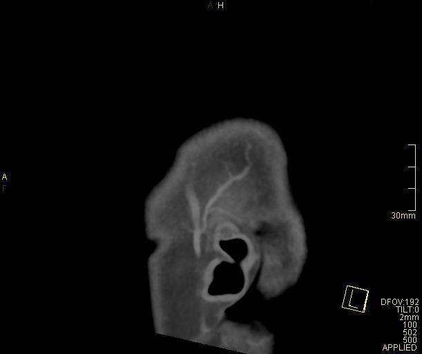 Cerebral venous sinus thrombosis (Radiopaedia 91329-108965 Sagittal venogram 74).jpg