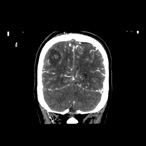 File:Cerebral venous throbmosis - hemorrhagic venous infarction (Radiopaedia 87318-103613 Coronal CT venogram 32).jpg