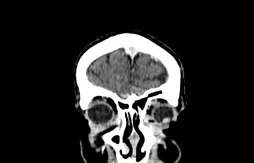 Cerebral venous thrombosis (CVT) (Radiopaedia 77524-89685 C 3).jpg