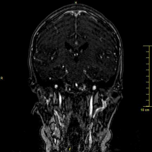 Cerebral venous thrombosis (Radiopaedia 23288-23351 MRV 82).JPG