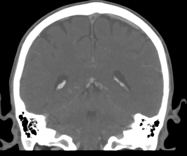 Cerebral venous thrombosis (Radiopaedia 38392-40467 Coronal CTA-Venogram 42).png
