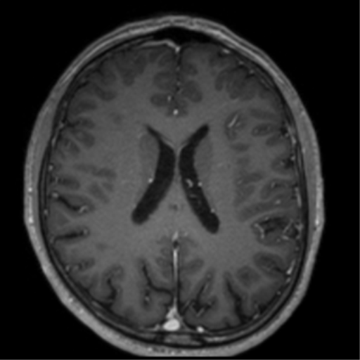 Cerebral venous thrombosis (Radiopaedia 38392-40469 Axial T1 C+ 49).png