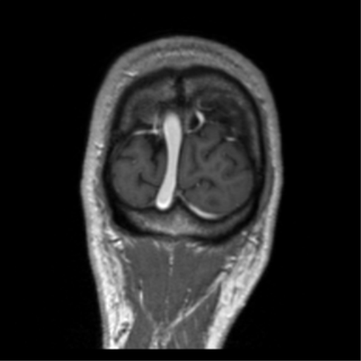 Cerebral venous thrombosis (Radiopaedia 38392-40469 Coronal T1 C+ 7).png