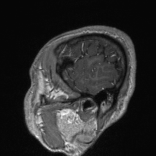 Cerebral venous thrombosis (Radiopaedia 38392-40469 Sagittal T1 C+ 14).png