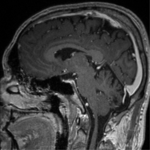 Cerebral venous thrombosis (Radiopaedia 38392-40469 Sagittal T1 C+ 48).png