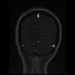 Cerebral venous thrombosis - ulcerative colitis (Radiopaedia 66049-75219 Coronal MRV 23).jpg