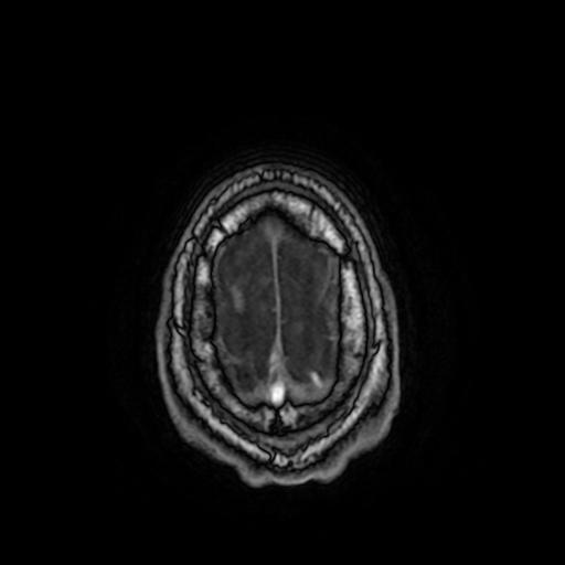 File:Cerebral venous thrombosis with secondary intracranial hypertension (Radiopaedia 89842-106957 Axial T1 156).jpg