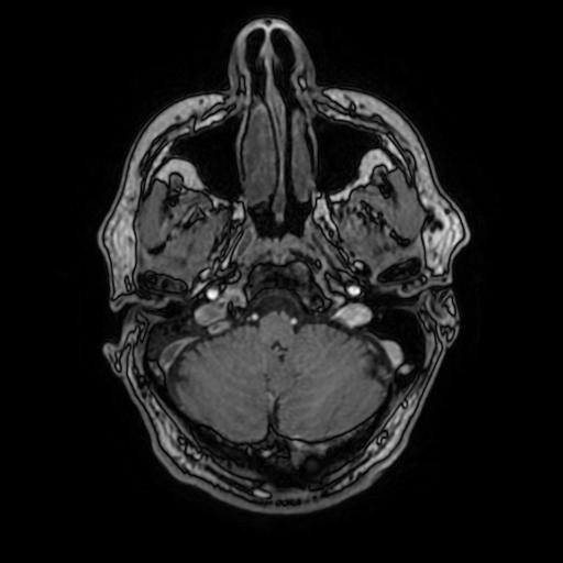 File:Cerebral venous thrombosis with secondary intracranial hypertension (Radiopaedia 89842-106957 Axial T1 C+ 45).jpg