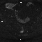 Cervical adenocarcinoma (Radiopaedia 65011-73985 Axial DWI 63).jpg