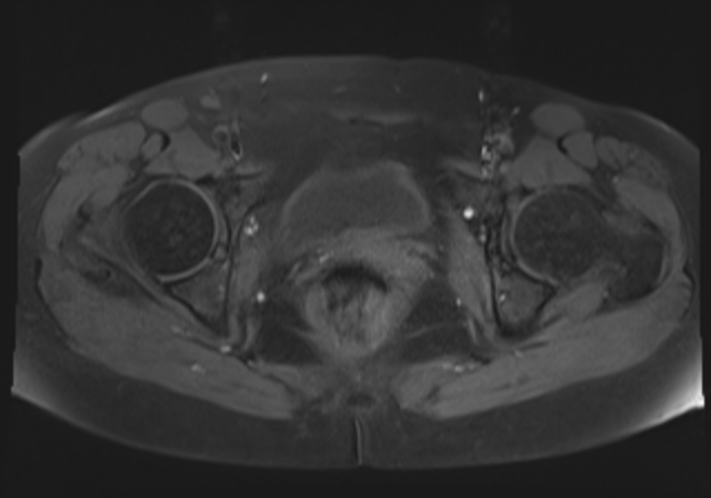 File:Cervical carcinoma (Radiopaedia 88312-104943 Axial T1 fat sat 16).jpg