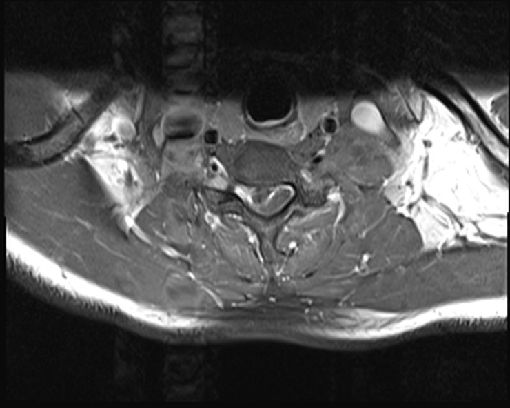 File:Cervical disc extrusion (Radiopaedia 53950-60077 Axial T1 C+ fat sat 21).jpg