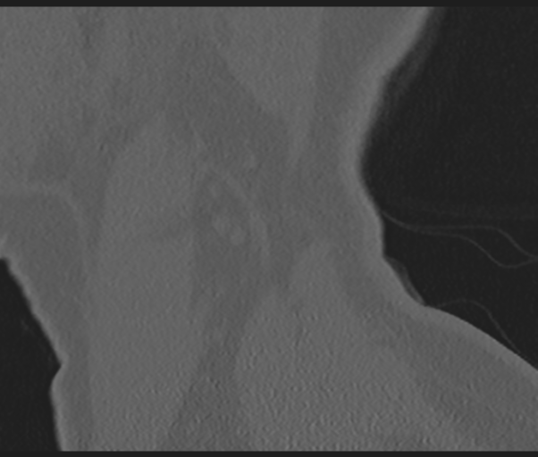 Cervical disc replacement (Radiopaedia 44025-47541 Sagittal bone window 78).png