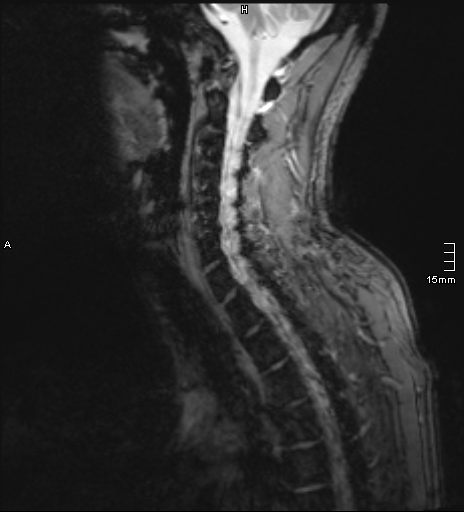 File:Cervical dural CSF leak on MRI and CT treated by blood patch (Radiopaedia 49748-54995 D 8).png