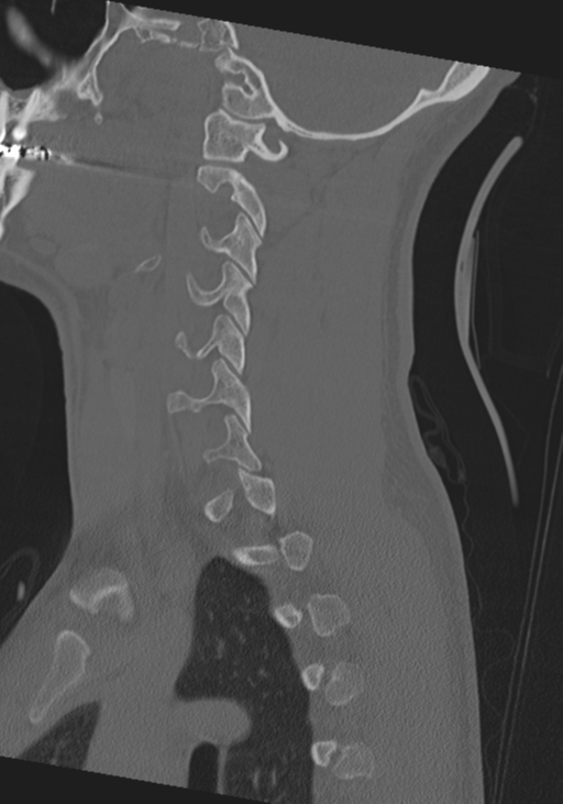 Cervical intercalary bone (Radiopaedia 35211-36748 Sagittal bone window 55).png