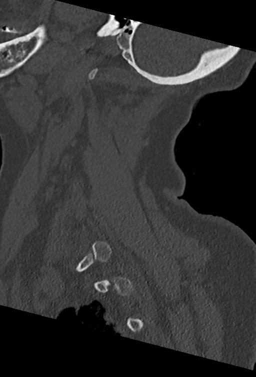 Cervical spine ACDF loosening (Radiopaedia 48998-54070 Sagittal bone window 68).png