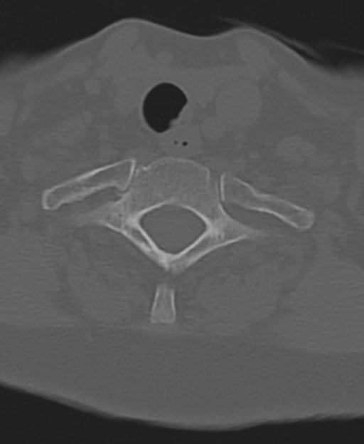 Cervical spine ACDF loosening (Radiopaedia 48998-54071 Axial bone window 49).png