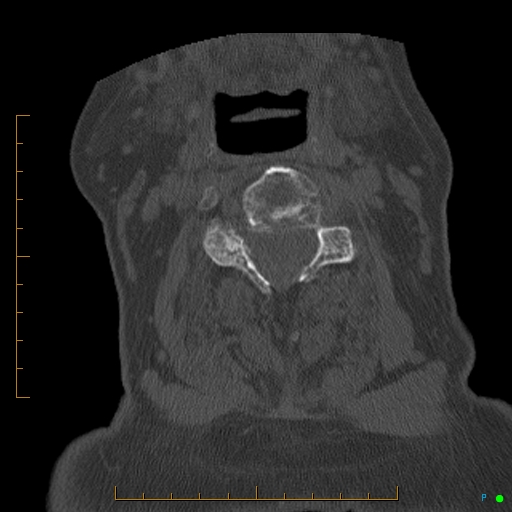 Cervical spine fracture - ankylosing spondylitis (Radiopaedia 76835-88706 Axial bone window 97).jpg