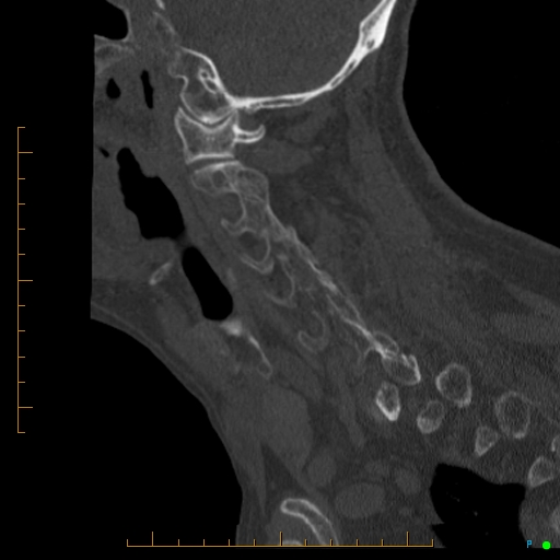 Cervical spine fracture - ankylosing spondylitis (Radiopaedia 76835-88706 Sagittal bone window 79).jpg