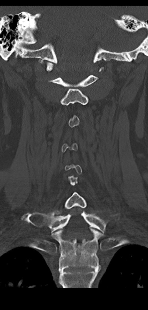 Cervical spine fracture - chalk stick (Radiopaedia 39116-41323 Coronal bone window 33).png