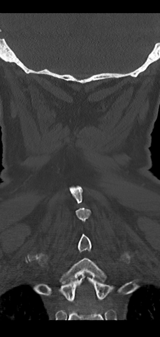 Cervical spine fracture - chalk stick (Radiopaedia 39116-41323 Coronal bone window 43).png
