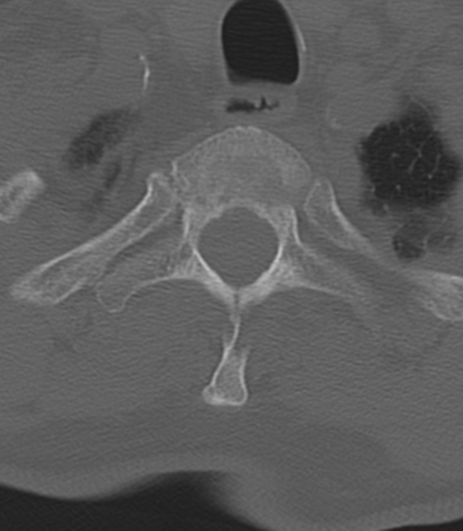 Cervical spine fractures with vertebral artery dissection (Radiopaedia 53296-59268 Axial bone window 52).png
