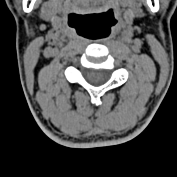 File:Cervical spondylodiscitis (Radiopaedia 28057-29489 Axial non-contrast 30).jpg