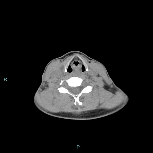 Cervical thymic cyst (Radiopaedia 88632-105335 Axial non-contrast 52).jpg