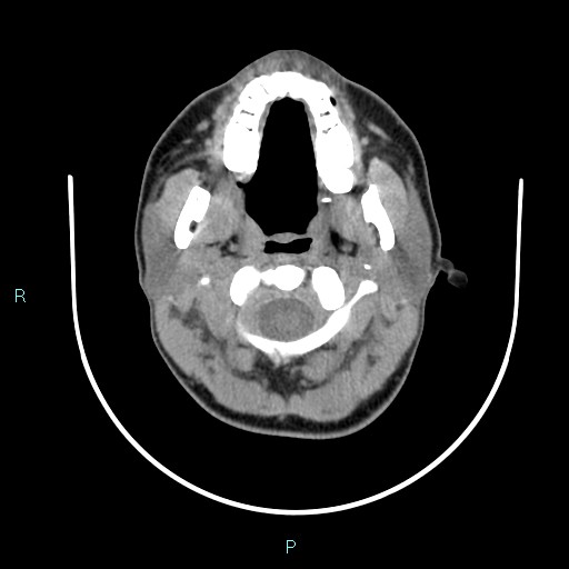 File:Cervical thymic cyst (Radiopaedia 88632-105335 Axial non-contrast 92).jpg