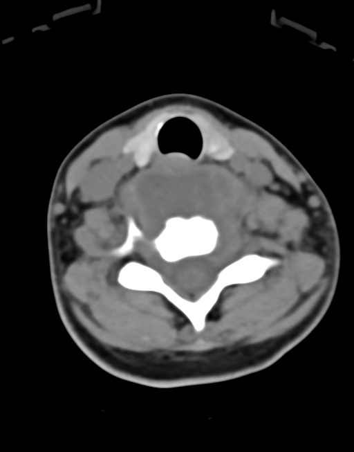 Cervical tuberculous spondylitis (Radiopaedia 39149-41365 Axial non-contrast 36).png