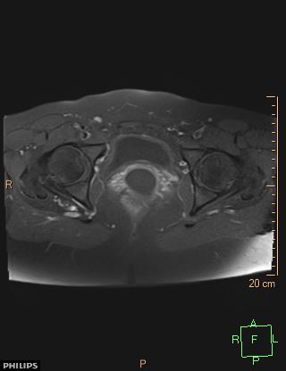 File:Cesarian scar endometriosis (Radiopaedia 68495-78066 Axial T1 C+ fat sat 20).jpg