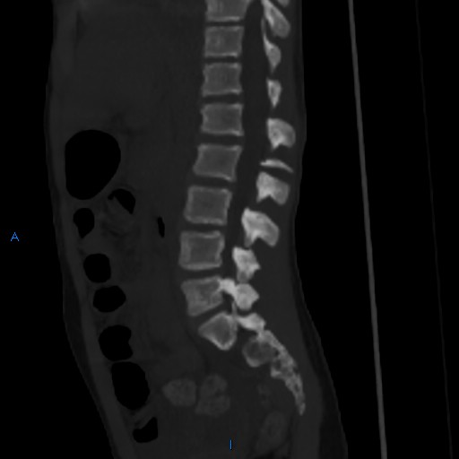 File:Chance fracture with duodenal and pancreatic lacerations (Radiopaedia 43477-50042 Sagittal bone window 9).jpg