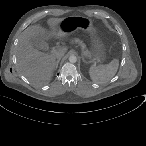 File:Chest multitrauma - aortic injury (Radiopaedia 34708-36147 A 288).png