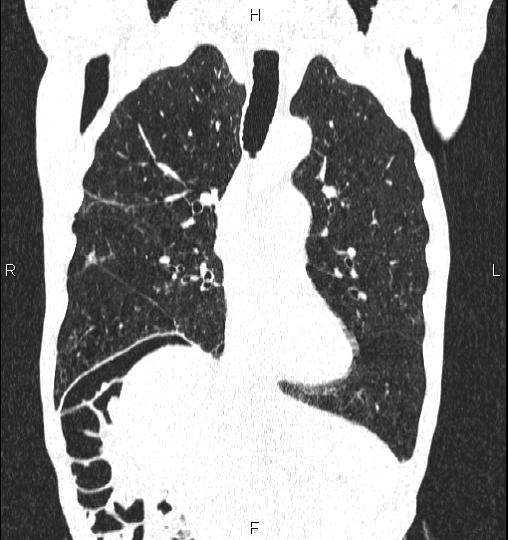 Chilaiditi sign (Radiopaedia 88839-105611 Coronal lung window 27).jpg