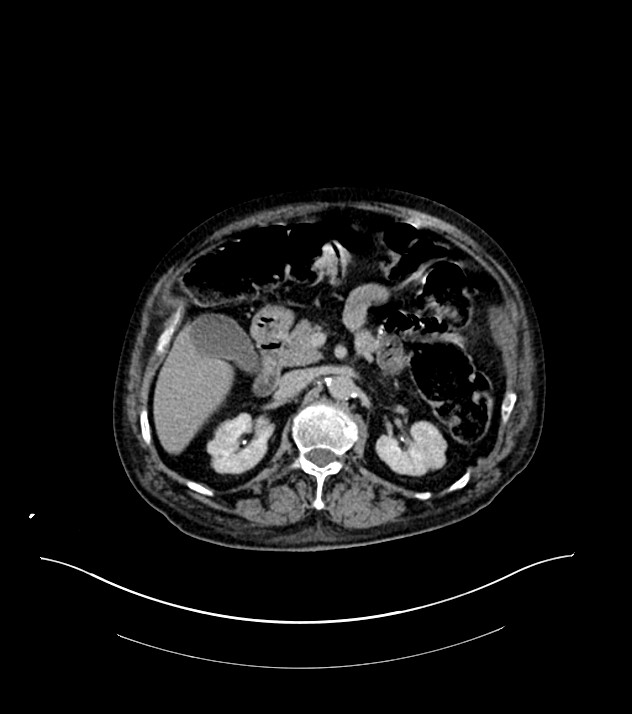 Cholangiocarcinoma with cerebral metastases (Radiopaedia 83519-98629 Axial C+ delayed 41).jpg