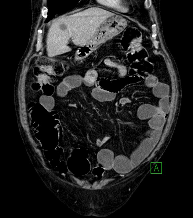 Cholangiocarcinoma with cerebral metastases (Radiopaedia 83519-98629 G 21).jpg