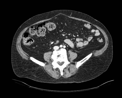 Cholecystoduodenal fistula (Radiopaedia 48959-54022 A 1).jpg