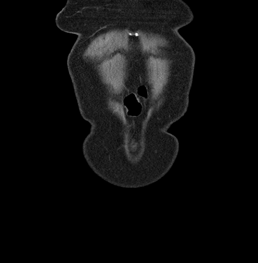 File:Cholecystoduodenal fistula due to calculous cholecystitis with gallstone migration (Radiopaedia 86875-103077 B 4).jpg