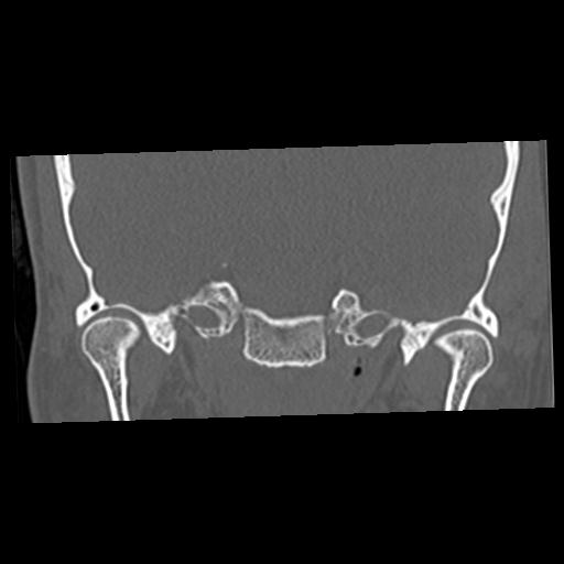 File:Cholesteatoma (Radiopaedia 84960-100474 Coronal bone window 21).jpg