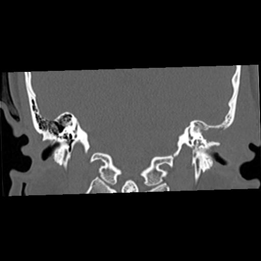 Cholesteatoma (Radiopaedia 84960-100474 Coronal bone window 38).jpg